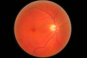Immagine del fondo oculare con i vasi della retina usata per lo screening della retinopatia diabetica