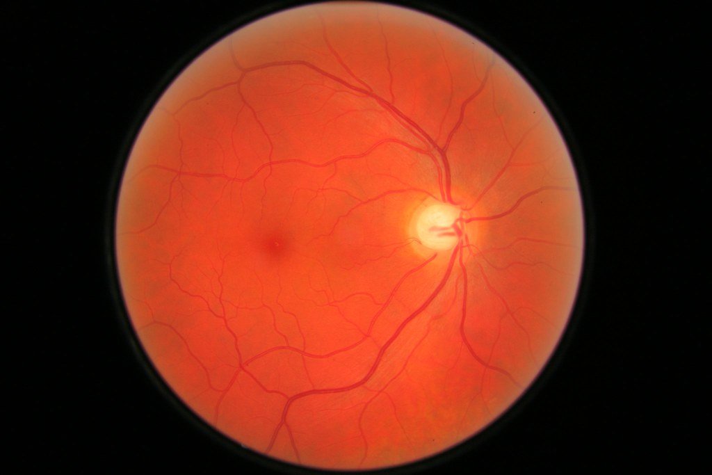 Immagine del fondo oculare con i vasi della retina usata per lo screening della retinopatia diabetica
