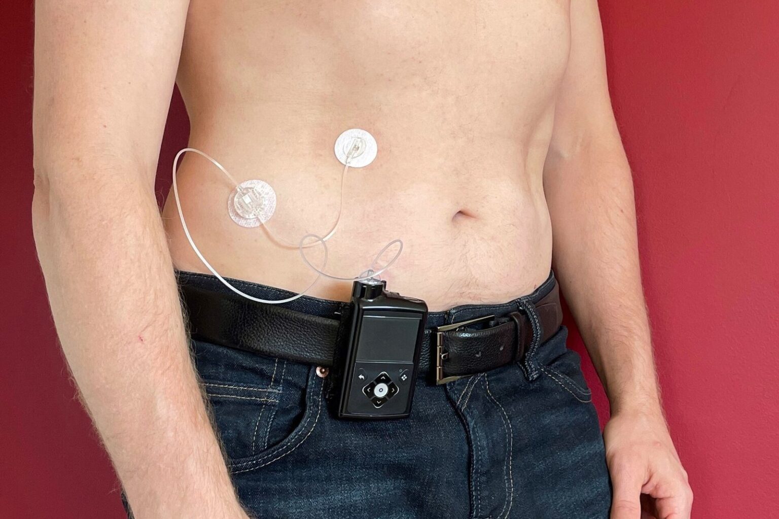 Microinfusore a cerotto senza tubi applicato sul braccio di una persona con diabete di tipo 1