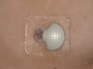 Operatore sanitario misura la glicemia con un glucometro durante uno screening del diabete