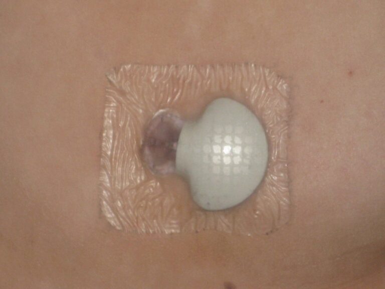 Operatore sanitario misura la glicemia con un glucometro durante uno screening del diabete