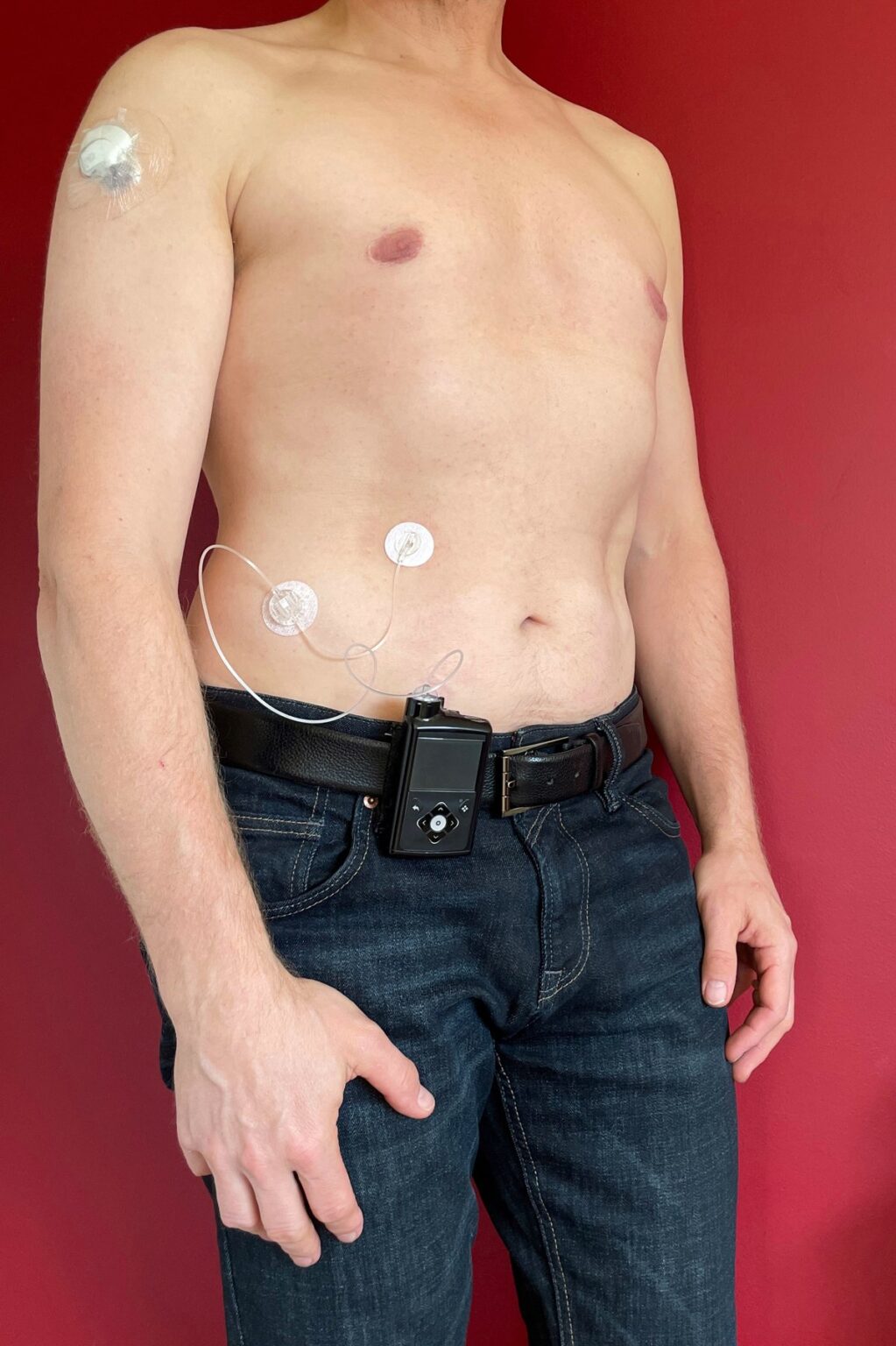 Uomo con microinfusore di insulina e sensore per il monitoraggio della glicemia
